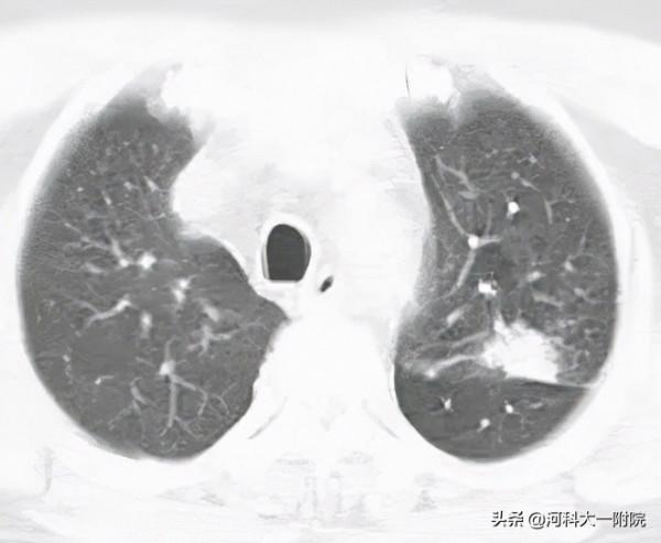“與癌共舞”一年半，鞘內化療讓帶癌生存成為可能