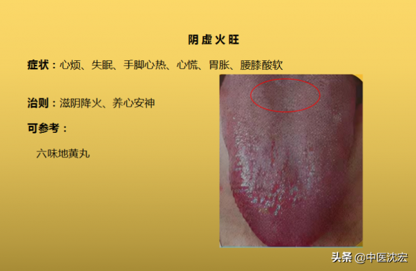 4種&OpenCurlyDoubleQuote;熱&rdquo;藏於體內，不同舌象，不同症狀，建議收藏分享給朋友