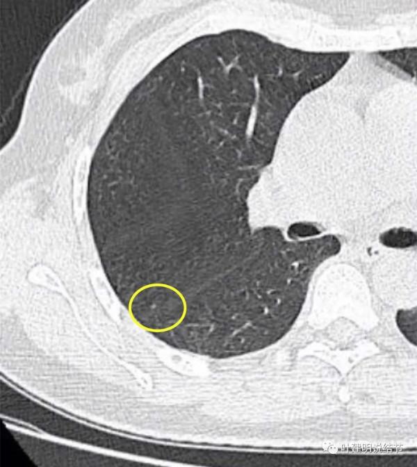指南說小於5毫米的肺結節不需要隨訪，打臉來了