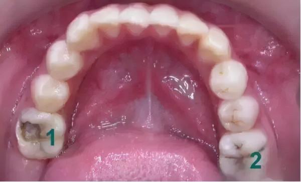 6-12歲換牙時間和換牙期問題大盤點！孩子一口好牙關鍵就在這幾點