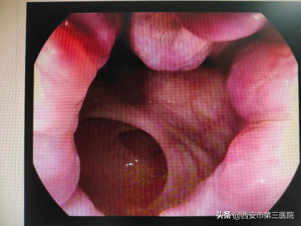 內痔與貧血丨內痔出血致重度/極重度貧血，內鏡止血立竿見影