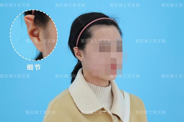 「科普」猿耳是招風耳嗎？兩者有什麼區別？