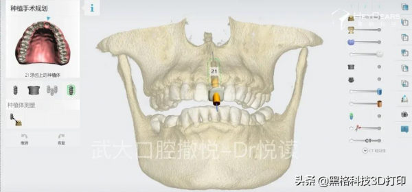 黑格科技丨病例分享：美學區即拔即種微創治療