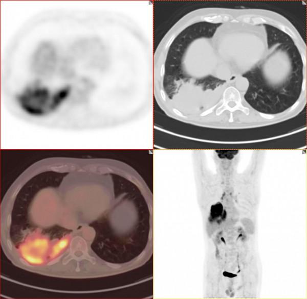 PET/CT病例（1）：晚期肺癌治療3個月，老人重現希望和曙光
