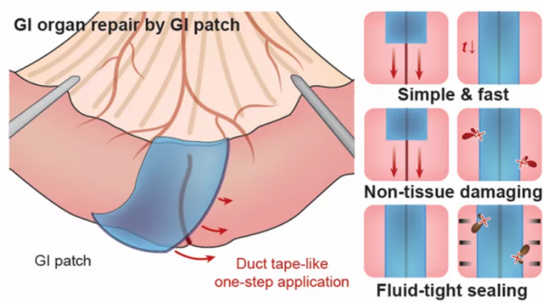 華科校友研發可降解&OpenCurlyDoubleQuote;腸道創可貼&rdquo;，能用於胃腸道缺損無縫修復