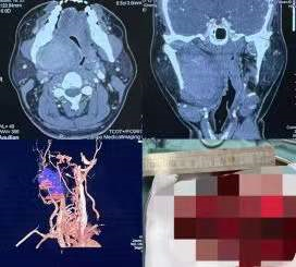 鼾聲如雷竟是腫瘤在作怪&mdash;&mdash;醫大口腔成功救治咽旁及顱底巨大腫物患者