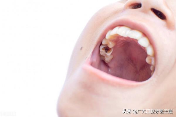 牙齒爛一半,先不要拔掉!還有這個辦法能補救 牙齒爛一半,先不要拔掉!還有這個辦法能補救