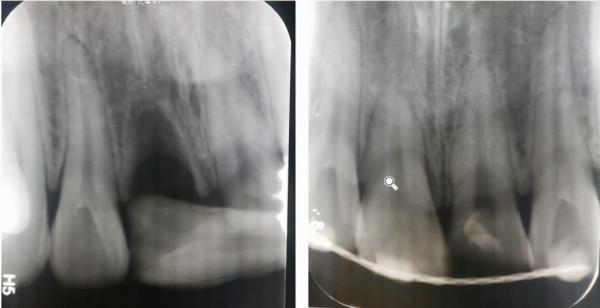 牙齒受了外傷，你知道該怎麼辦嗎？
