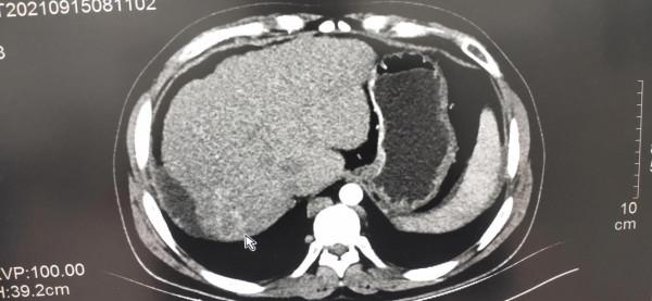 不明原因的下肢靜脈曲張、潰瘍及色素沉著——警惕布加綜合徵可能