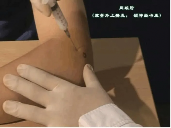 有一種胳膊痛叫“網球肘”！送上治療全攻略①