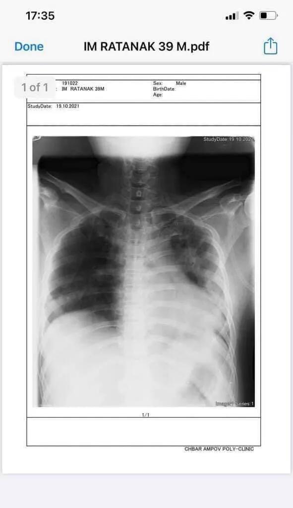 感染新冠作曲家：出現症狀後，僅24小時差點離開人世