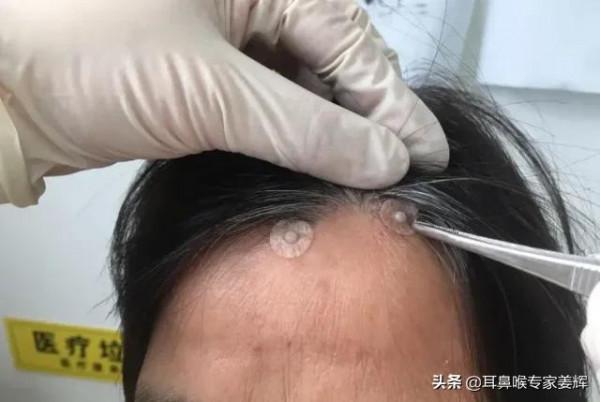 過敏性鼻炎如何用撳(qin)針治療 過敏性鼻炎如何用撳(qin)針治療