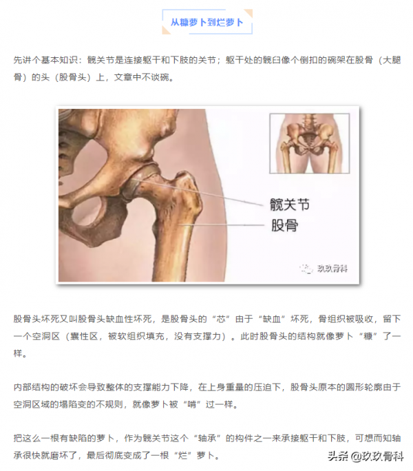 從&OpenCurlyDoubleQuote;硬&rdquo;骨頭到&OpenCurlyDoubleQuote;爛&rdquo;蘿蔔，股骨頭壞死都經歷了什麼？