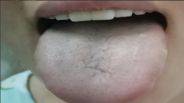 兩個位置測血瘀,一箇中成藥化淤血,4種血瘀體質瞭解一下 兩個位置測血瘀,一箇中成藥化淤血,4種血瘀體質瞭解一下