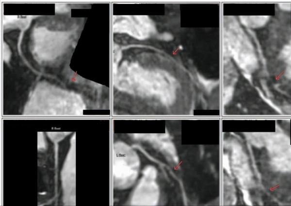 年僅49歲，竟發現冠脈中度狹窄