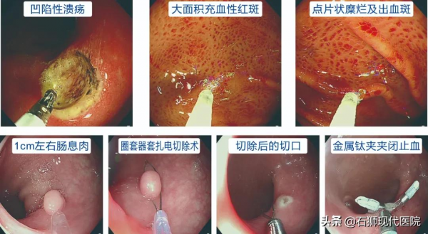 胃腸鏡檢查到底有多重要？三個胃腸道真實案例，讓人細思極恐