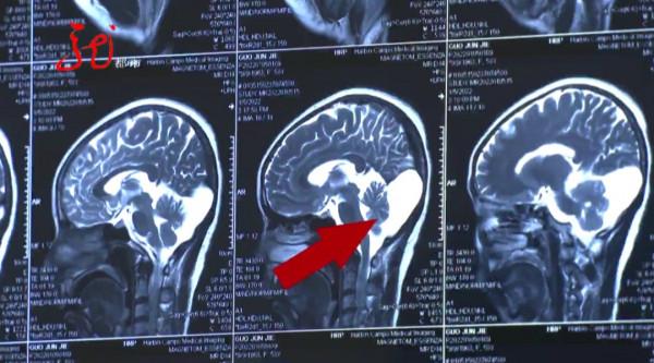 抽搐、噁心、頭部疼痛 顱內竟然長了個&OpenCurlyDoubleQuote;水袋&rdquo;