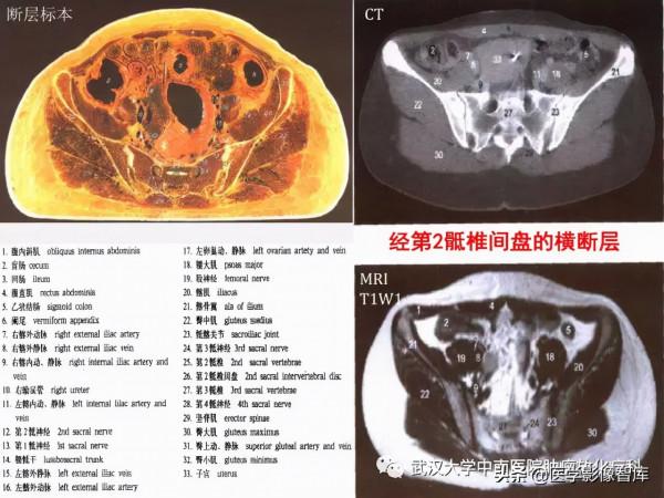 CT斷層解剖圖譜最全總結「推薦收藏」 CT斷層解剖圖譜最全總結「推薦收藏」