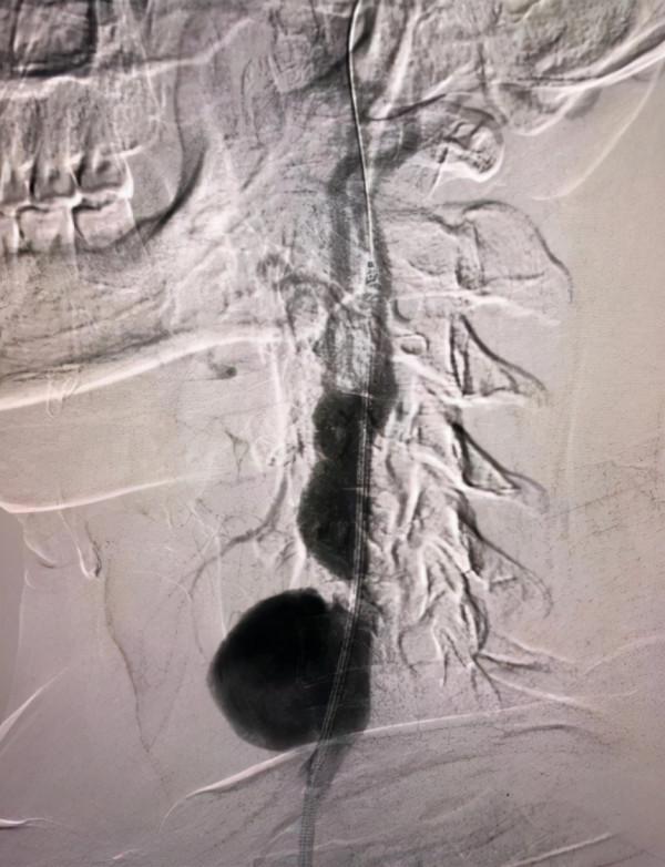 年輕小夥“甩頭”過猛，脖子鼓起一個“包”，血管差點破裂