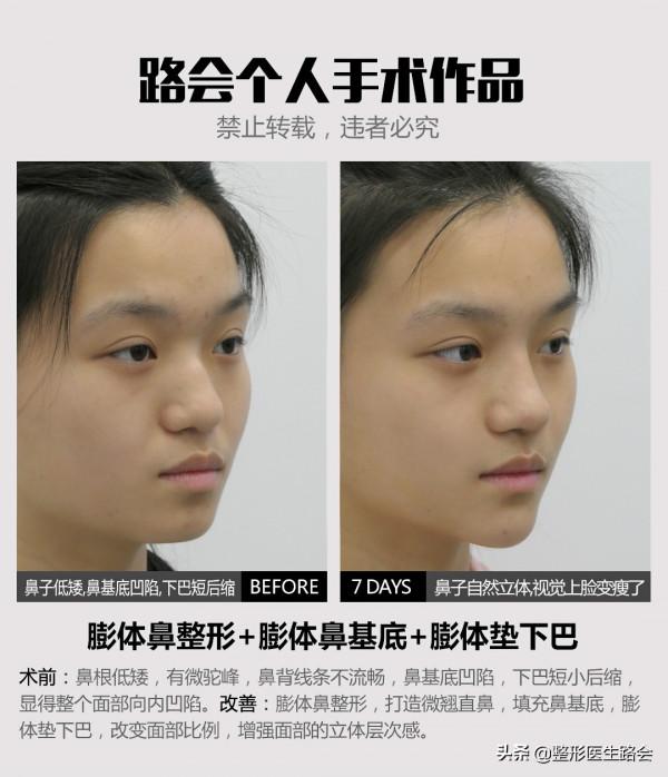 12種不適合做整形手術的行為，其中4種已被醫生列入“黑名單”