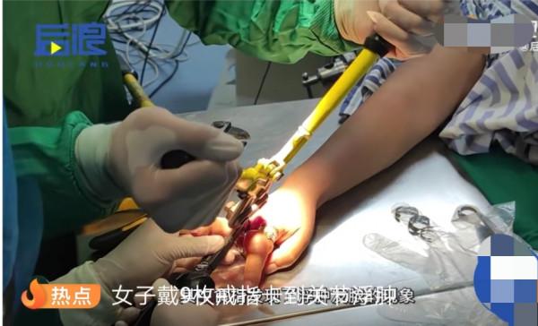 女子戴九枚戒指，結果戒指卡住取不出來，手指已經嚴重膿化