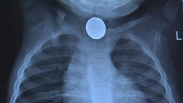 心痛！英國2歲嬰兒誤吞電池去世，心臟被燒破洞