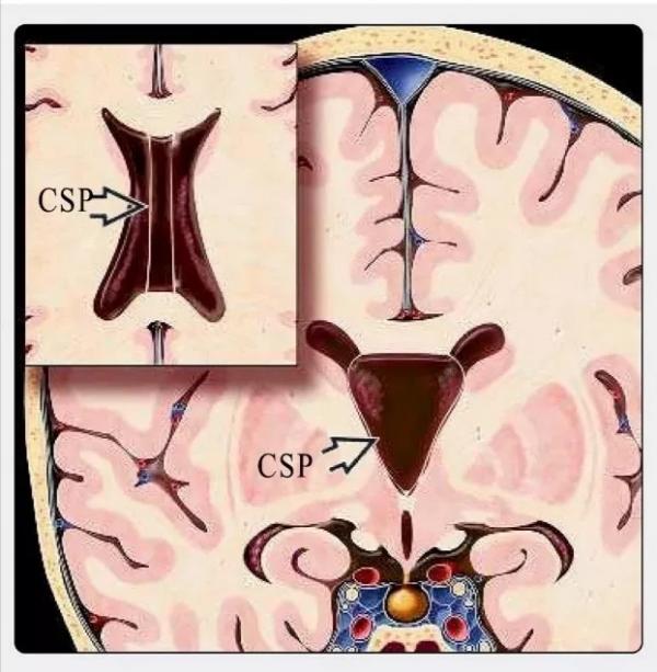“第五腦室”是透明隔腔嗎? “第五腦室”是透明隔腔嗎?