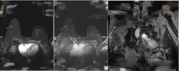 愈見未萊 | 赫帕雙靶新輔助治療HER-2+可手術乳腺癌患者，療效和安全性兼可得