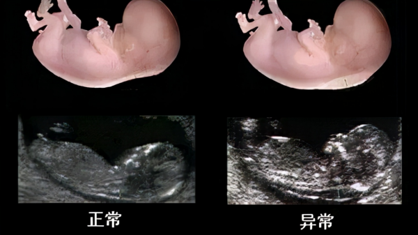 孩子高低肩、身子歪或許是半椎體畸形惹的禍，不要不當回事