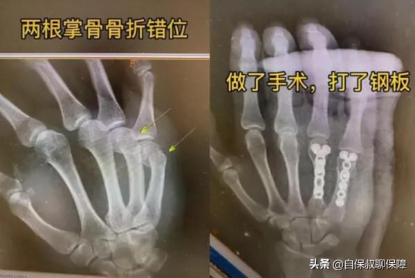 輔導孩子作業被氣到下巴脫臼,保險賠嗎? 輔導孩子作業被氣到下巴脫臼,保險賠嗎?