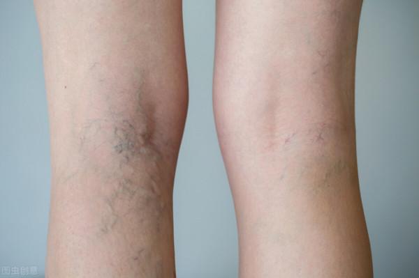 “青筋凸起”是因血管毒素淤積？小心這些部位的凸起，或是疾病