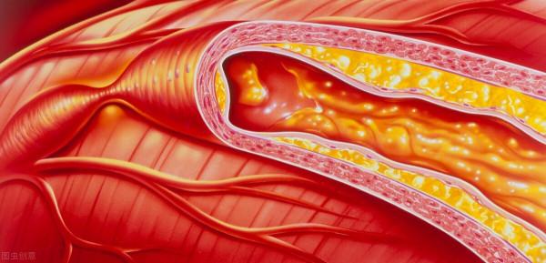 60多歲後每年需要“衝”血管?這個誤區,現在還有很多老人在做 60多歲後每年需要“衝”血管?這個誤區,現在還有很多老人在做