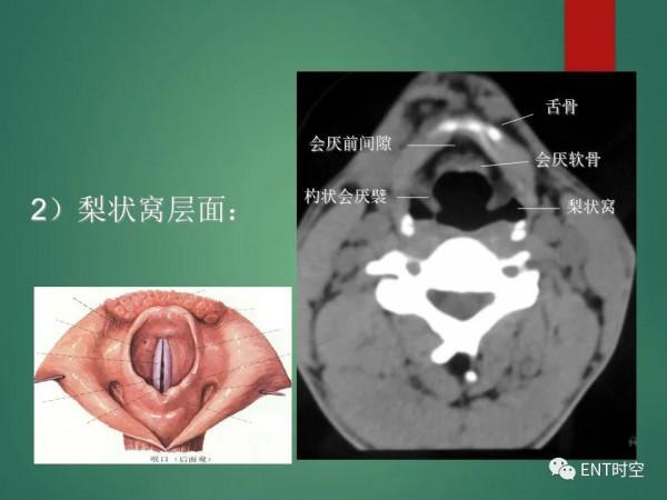 頭頸五官CT斷層解剖圖及常見病影像診斷