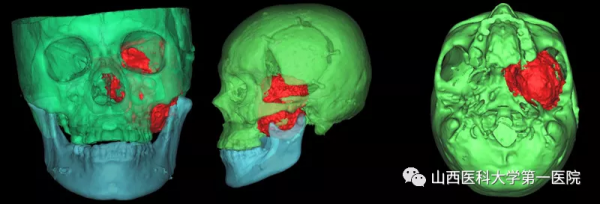 省內領先！山西醫科大學第一醫院多學科協作成功切除一例巨大顱底溝通性腫瘤