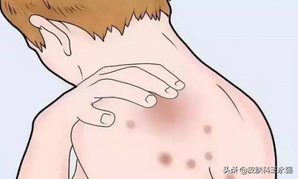 溼疹反覆發作怎麼辦？醫生教你三個小辦法，有效調理它