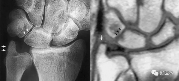 贊！腕關節X線高畫質解剖+腕骨脫位典型病例
