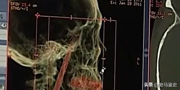 雲南30歲男子口臭駭人，只因&quot;腦中藏10釐米長刀&quot;，最終結局如何？