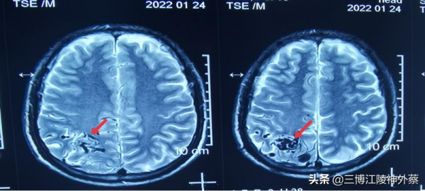 伽瑪刀臨床應用之：腦動靜脈的治療