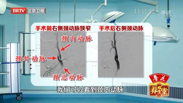 頭暈頭沉、反應力下降？可能是頸動脈出了大問題！2個檢查早發現