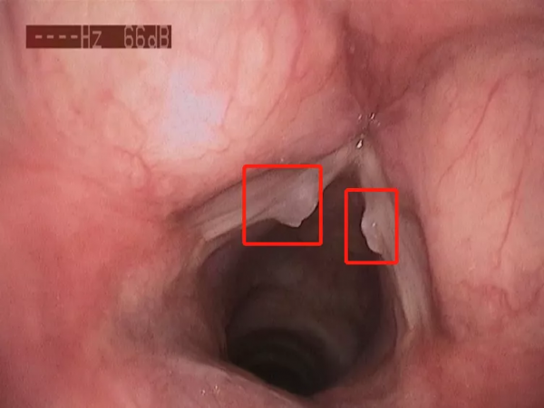 咽喉疼痛、聲音嘶啞,可能是這裡長了息肉啦 咽喉疼痛、聲音嘶啞,可能是這裡長了息肉啦