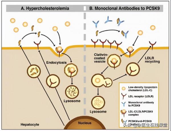 新型降脂藥獲批上市，降低心梗、腦卒中和血運重建風險