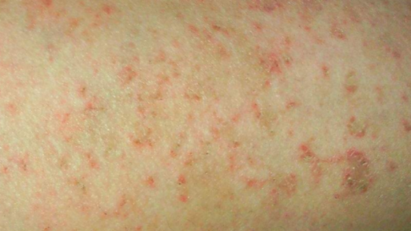 這2種皮膚疾病，無法被根治，但可以透過治療緩解