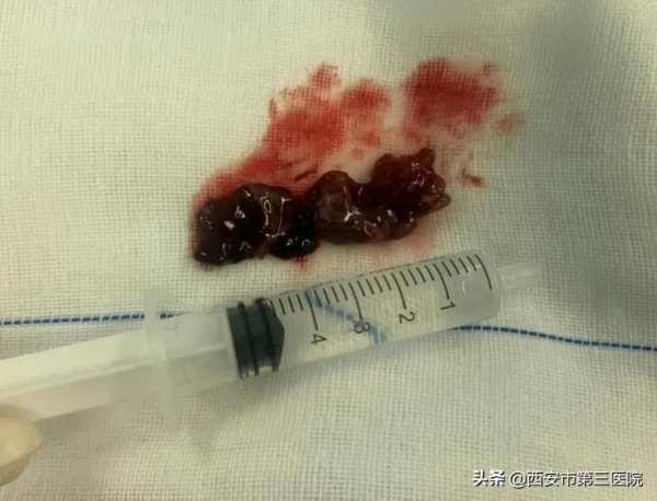 又雙叒叕流鼻血？耳鼻喉科成功切除一例少見兒童出血性鼻息肉