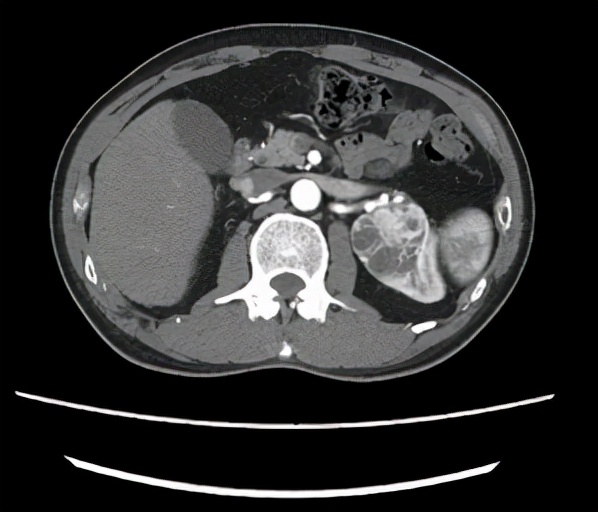 步入中年,體檢卻發現左腎上長了一顆“定時炸彈” 步入中年,體檢卻發現左腎上長了一顆“定時炸彈”