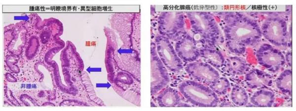 早期胃癌病理診斷：WHO VS.日本標準一文解析