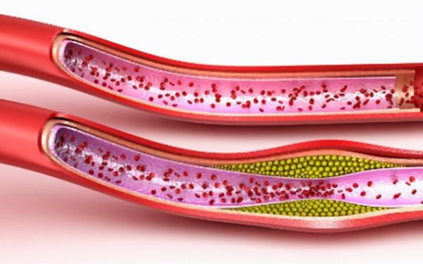 常有心絞痛症狀是怎麼回事？如何養生可預防心絞痛的發生？