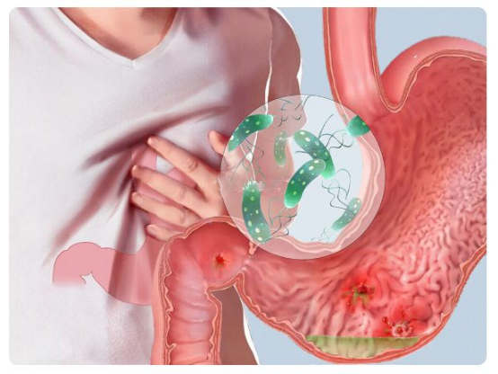 奧美拉唑、蘭索拉唑、泮托拉唑、雷貝拉唑有何區別？哪個作用最好