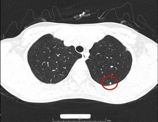 問診分析：兩肺多發實性結節，各科各醫院意見不一，如何是好？