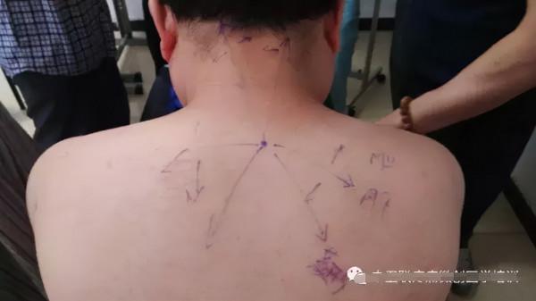 中醫治療頸椎病大全，全是乾貨