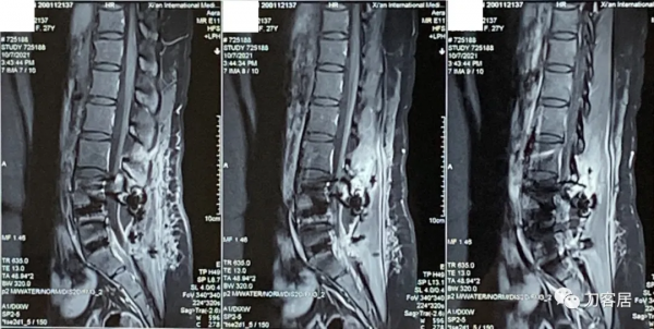 27歲女性，兩間隙腰椎間盤突出症，6顆釘子，4個融合器
